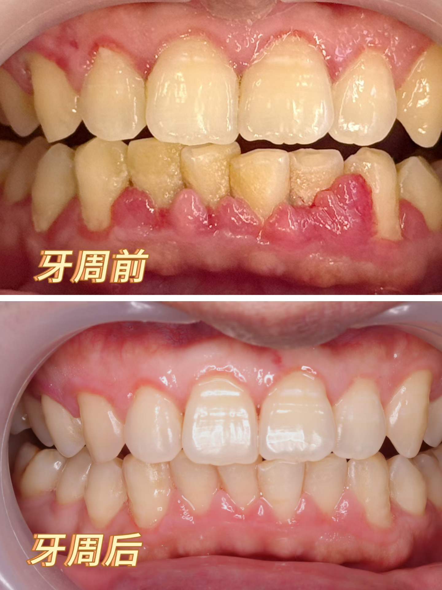 牙周治疗